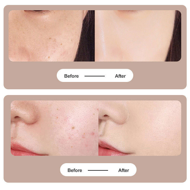 Mole Removal Plasma Pen Laser Facial Freckle Dark Spot