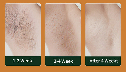 Laser Hair Removal